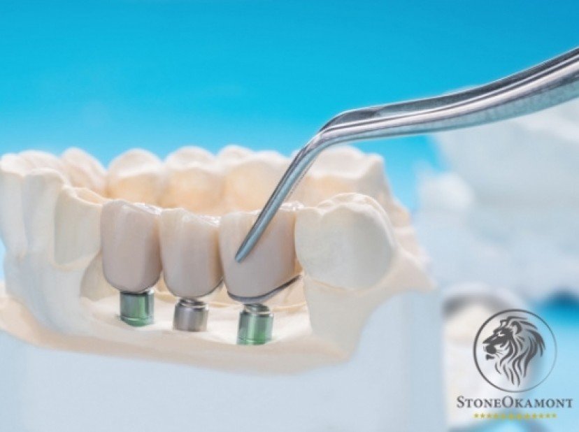 How to sell dental implant in Brazil