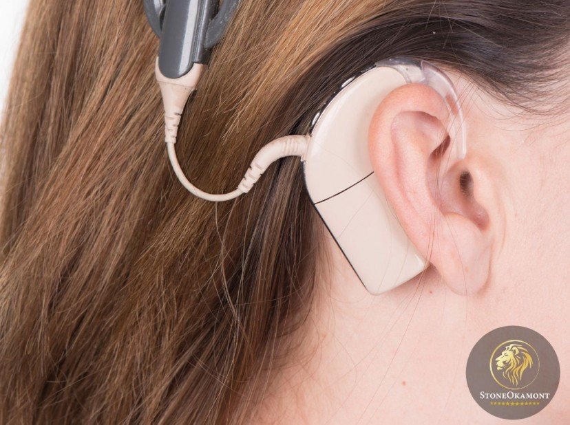 How to register cochlear implant?